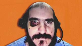 photo of detainee Raiko Lopez Morffi with black eye | Katie Blankenship/U.S. District Court for the Middle District of Florida