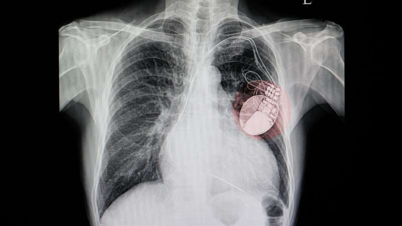 A chest X-ray of a patient with a cardiac pacemaker. | Sopone Nawoot | Dreamstime.com