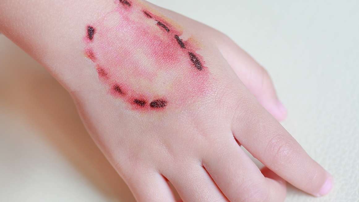 Human Bite Marks On Skin