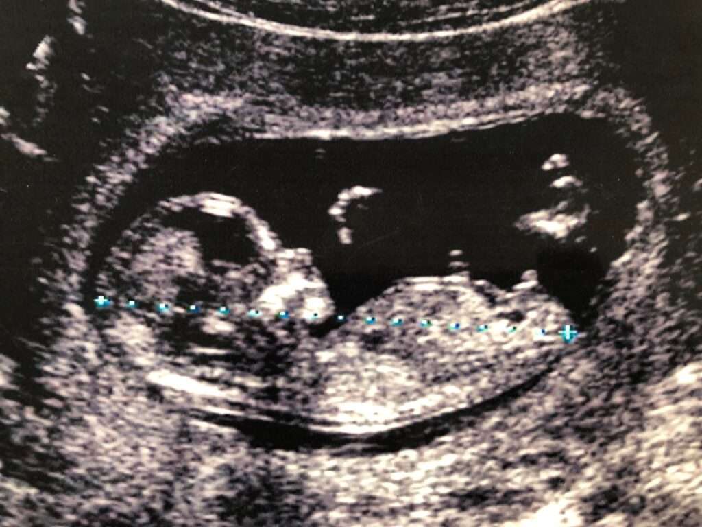 ultrasound image of fetus