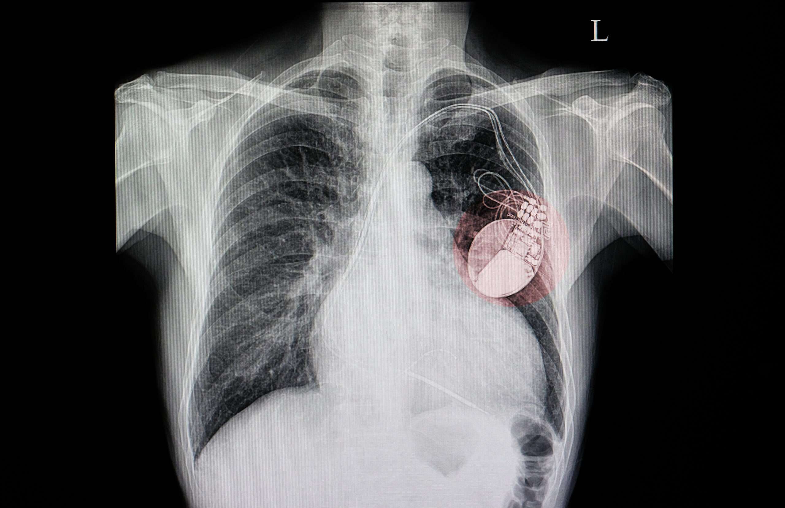 Pacemakers Might Be Vulnerable to Hackers