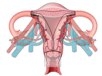 UterusTransplant