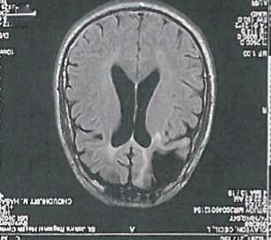 Cecil Clayon's brain scan