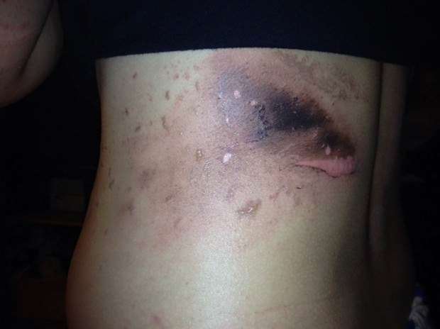 12-Year-Old Girl Has Second Degree Burns From SWAT Flash Grenade Detonated  During Wrong-Door Raid